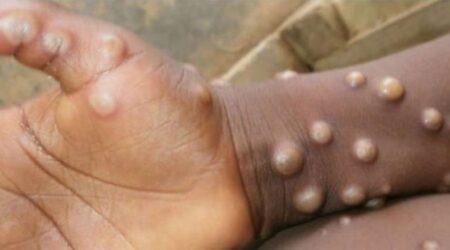 Meymunçiçəyinə yoluxma 20% artıb