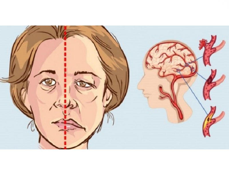 ABŞ cərrahları: keçici işemik hücum insultdan əvvəl ola bilər
