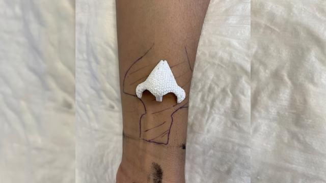 Xərçənglə mübarizə aparan qadın qolunda yeni burun böyütdü