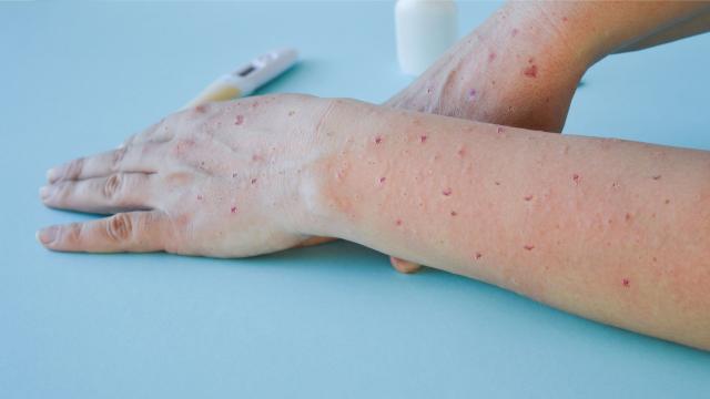 ÜST meymun çiçəyi virusunun adını “Mpox” adlandıracaq