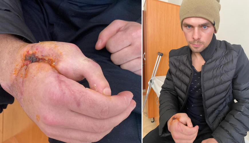 Kəsilmiş əl barmağının yerinə ayaq barmağı tikildi – VİDEO